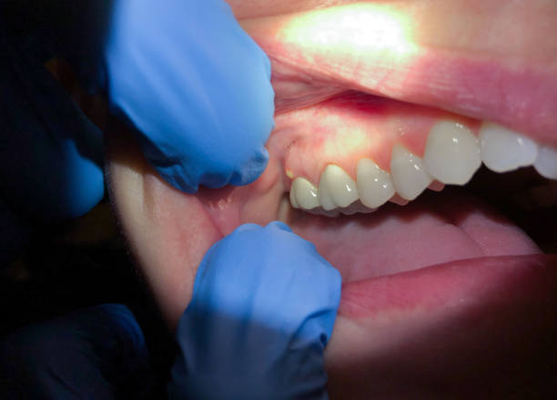 Best Emergency Dentist for Lost Fillings or Crowns in South Apopka, FL